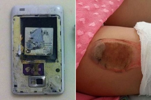 Smartfon wybuchł w kieszeni 7-letniej dziewczynki